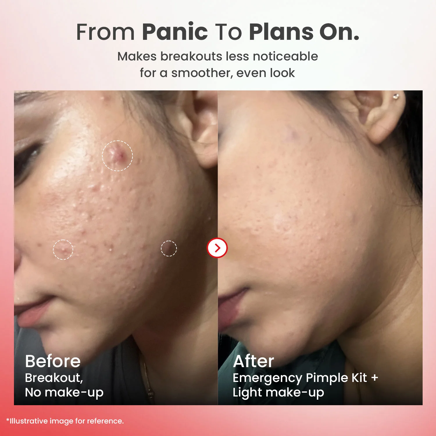 Emergency Acne Kit - Image 7